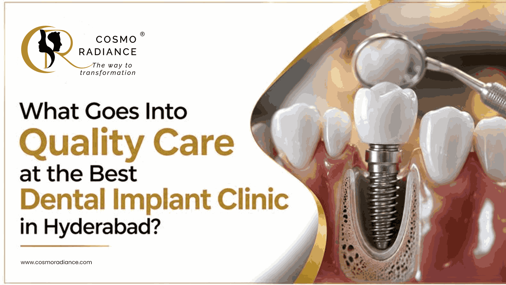 What Goes Into Quality Care at the Best Dental Implant Clinic in Hyderabad?