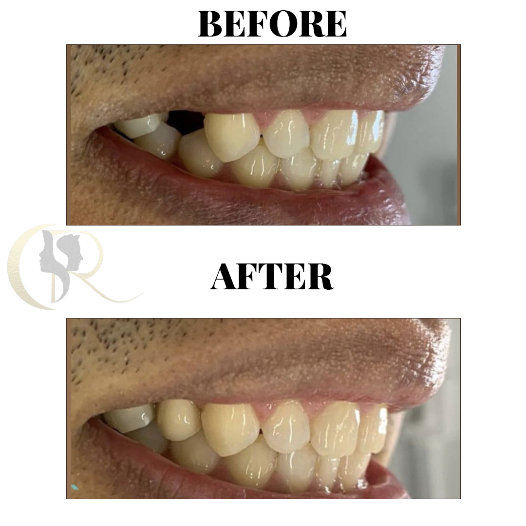 Advanced Dental Implants & Full Mouth Rehabilitation in Hyderabad