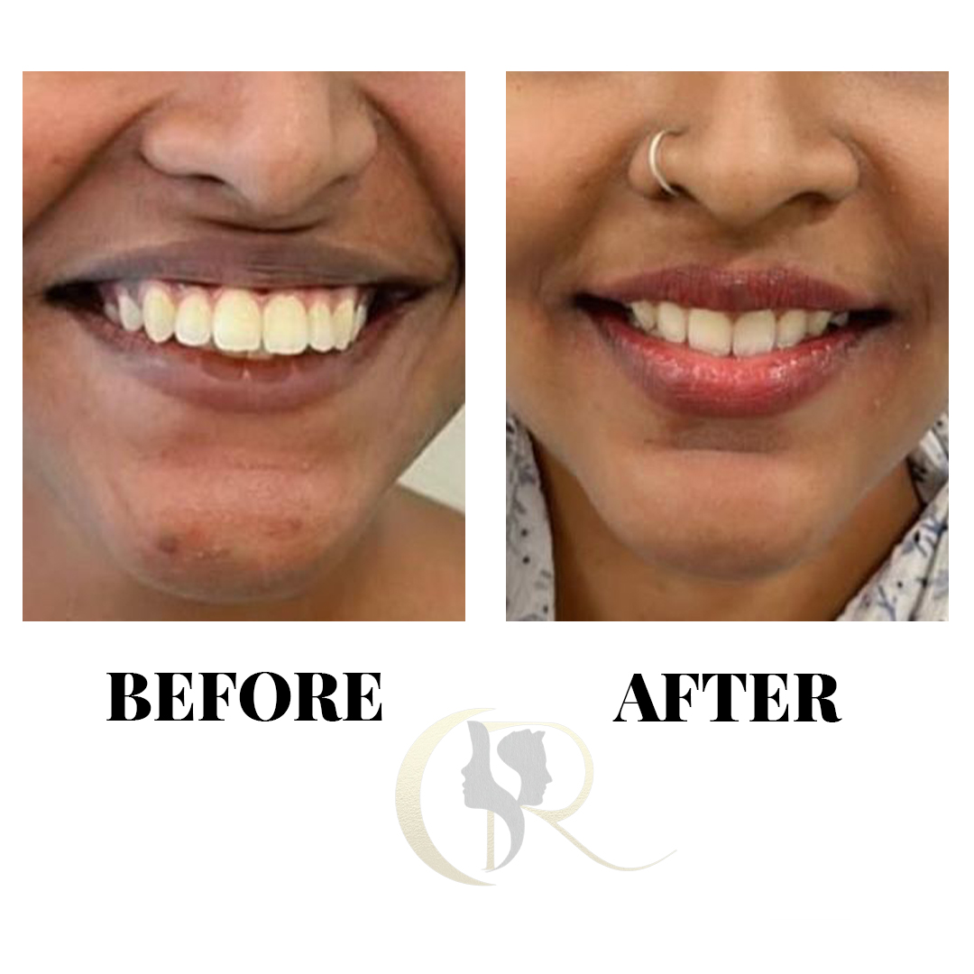 Advanced Clear Aligners in Hyderabad: Discreet Teeth Straightening