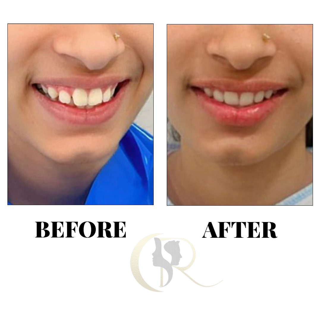 Advanced Clear Aligners in Hyderabad: Discreet Teeth Straightening
