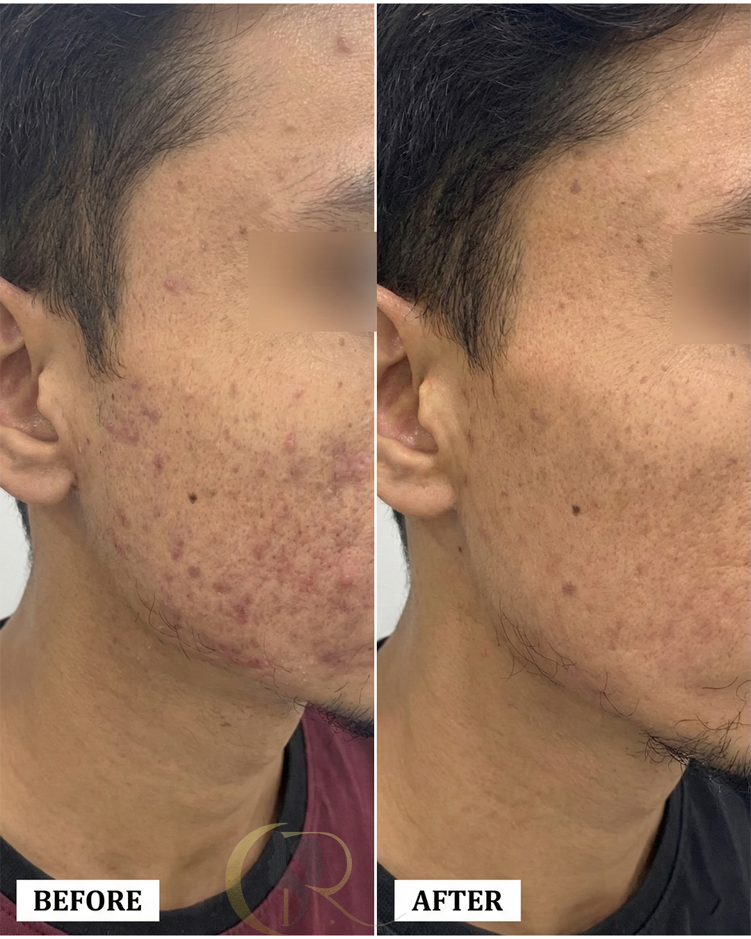 Advanced Laser Treatment for Acne Scars in Hyderabad | From ₹4,000