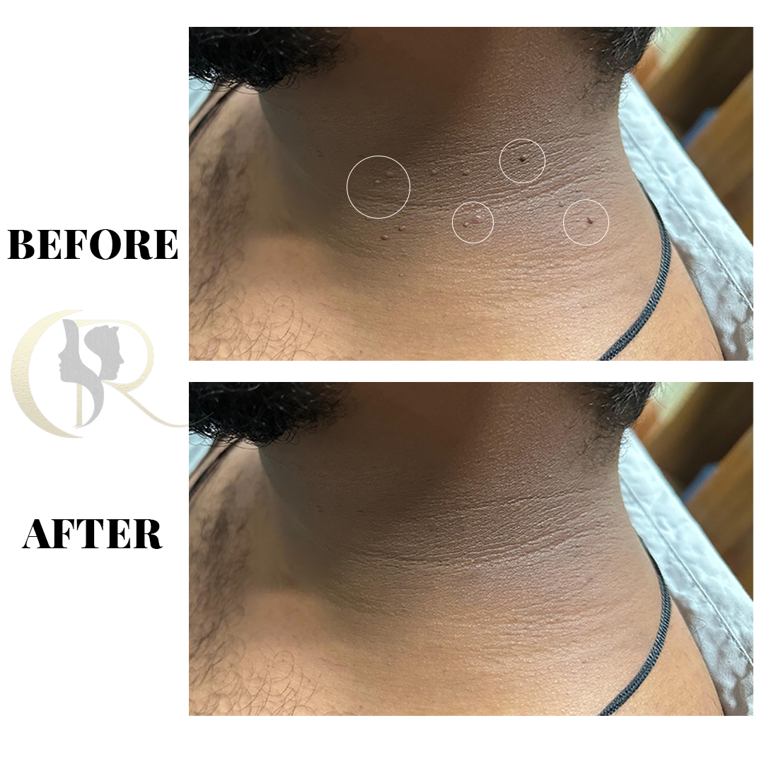 Advanced Mole, Wart &amp; Skin Tag Removal in Hyderabad | Clear Skin Solutions