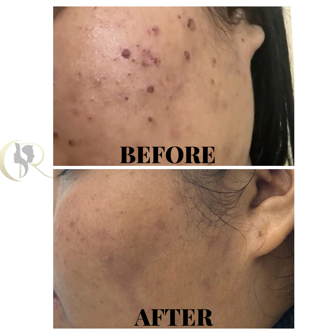 Advanced Laser Treatment for Acne Scars in Hyderabad | From ₹4,000