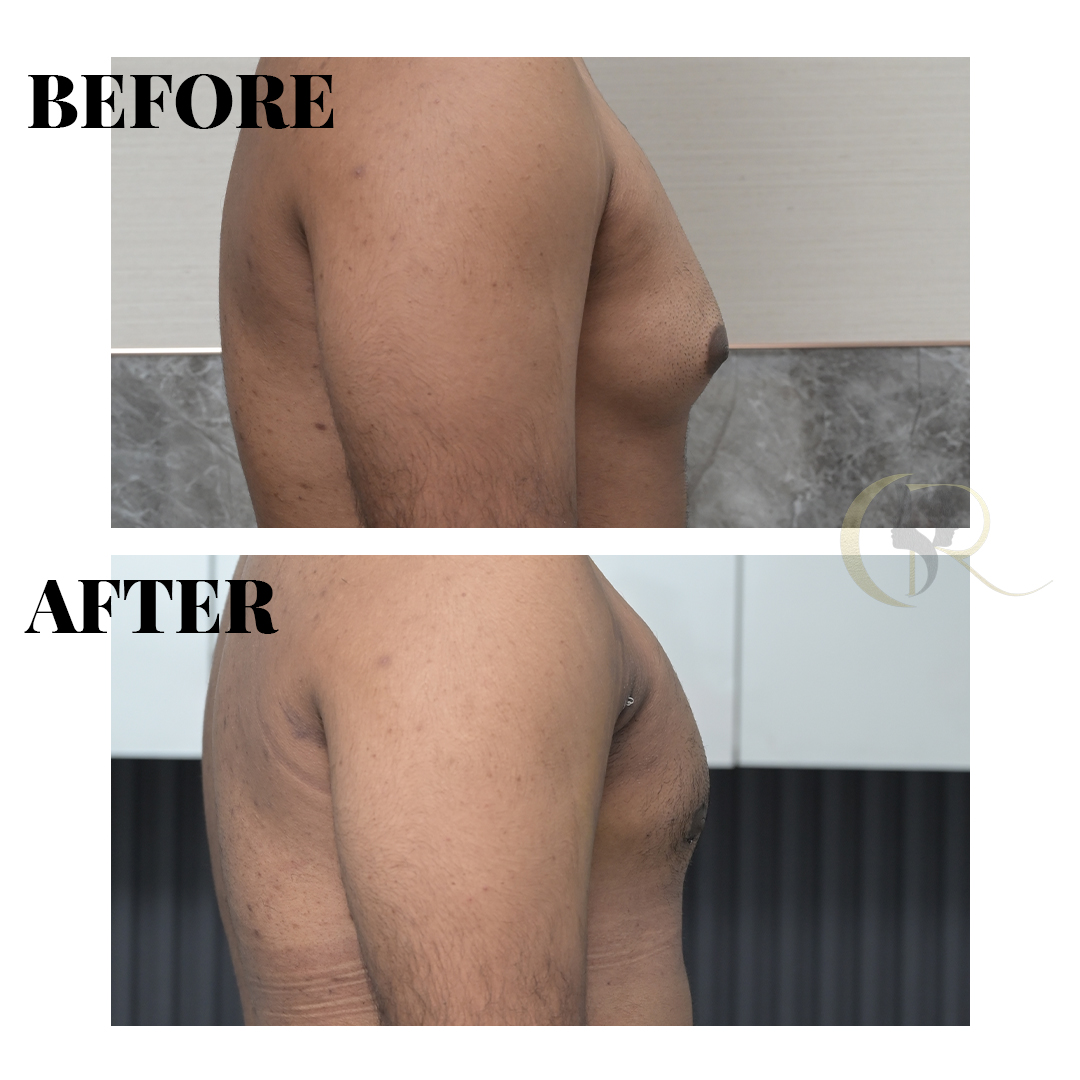 Gynecomastia Surgery in Hyderabad | Male Chest Reduction by M.Ch Surgeons