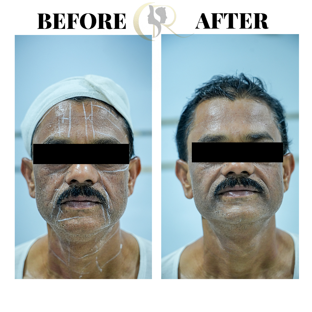 Advanced HIFU Non-Surgical Facelift in Hyderabad