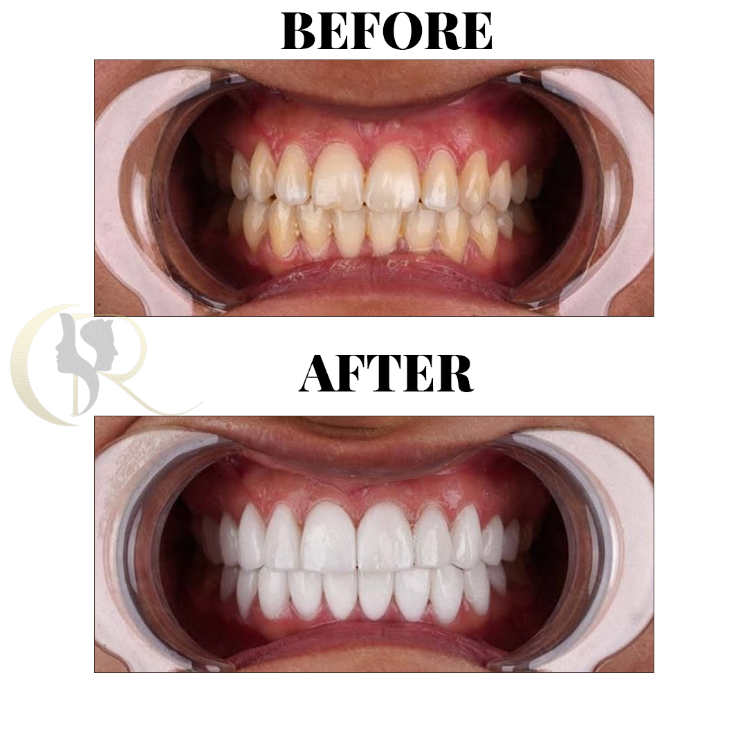 Professional Teeth Whitening in Hyderabad: Pola Office LED System