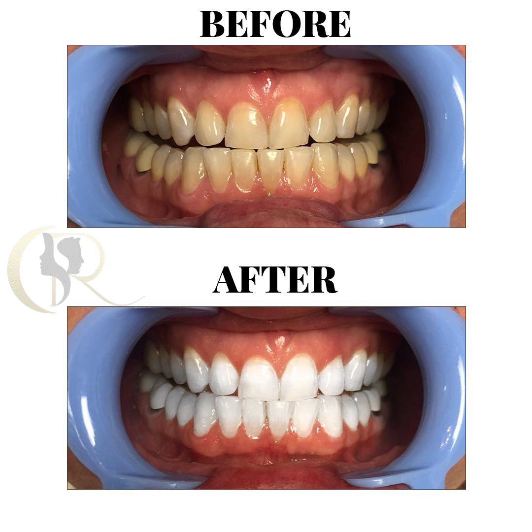 Professional Teeth Whitening in Hyderabad: Pola Office LED System