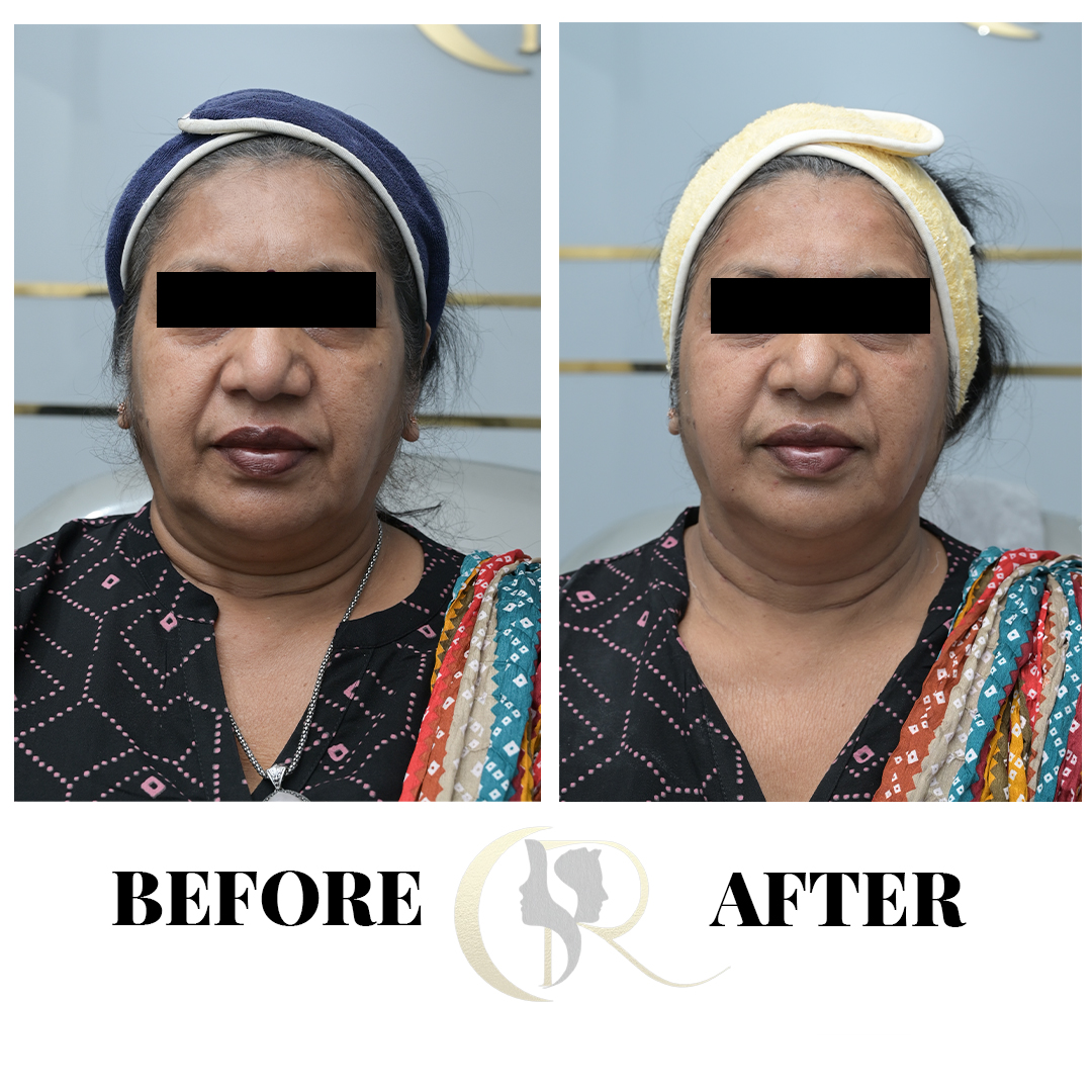 Advanced HIFU Non-Surgical Facelift in Hyderabad