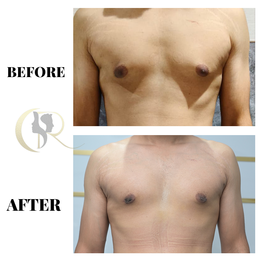 Gynecomastia Surgery in Hyderabad | Male Chest Reduction by M.Ch Surgeons