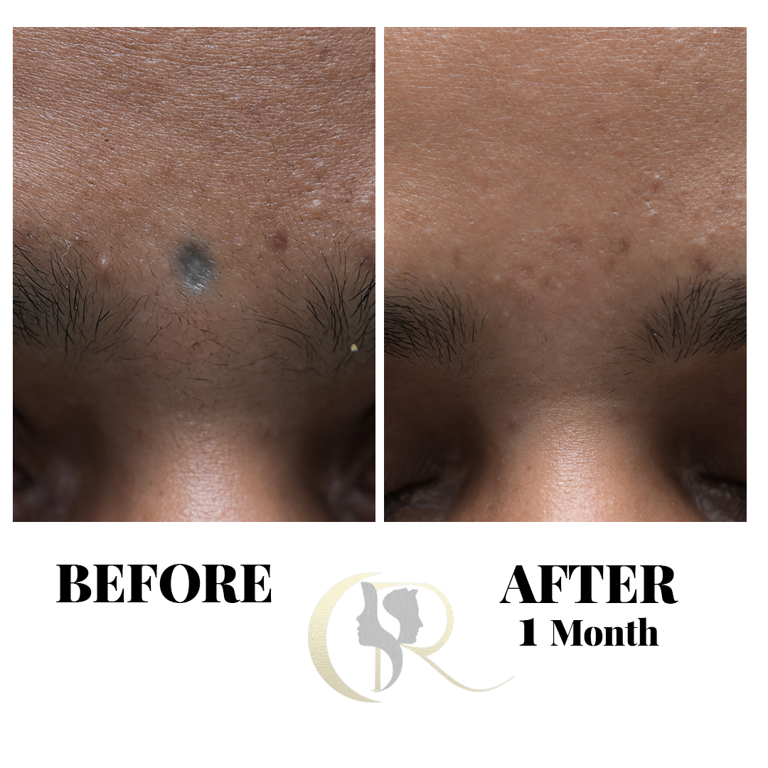Advanced Tattoo Removal in Hyderabad | Pico Laser & Surgical Options