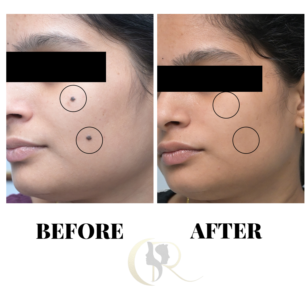 Advanced Mole, Wart &amp; Skin Tag Removal in Hyderabad | Clear Skin Solutions