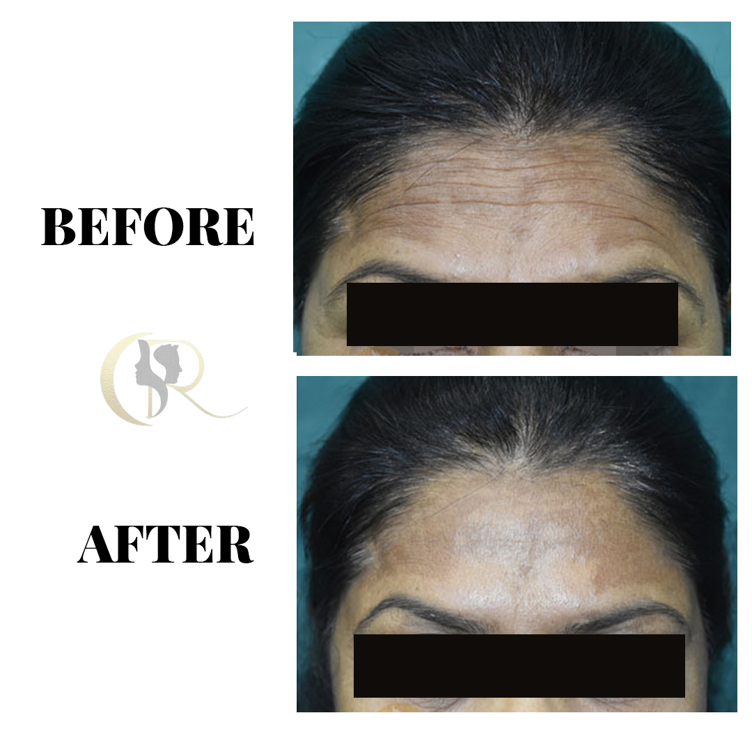Advanced HIFU Non-Surgical Facelift in Hyderabad