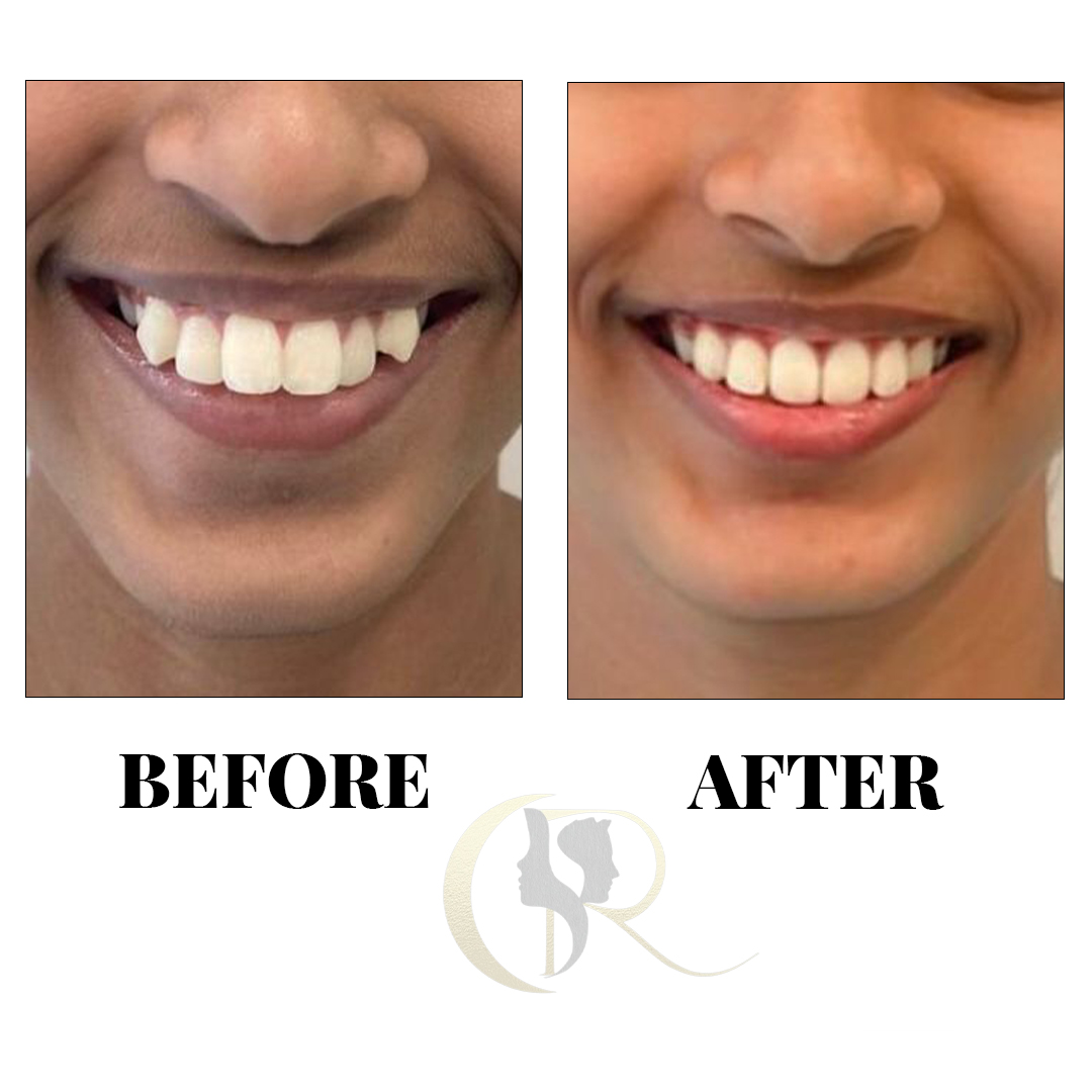 Advanced Clear Aligners in Hyderabad: Discreet Teeth Straightening