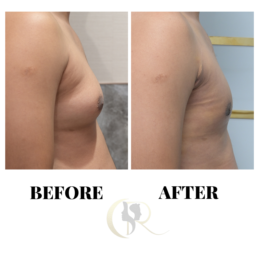 Gynecomastia Surgery in Hyderabad | Male Chest Reduction by M.Ch Surgeons