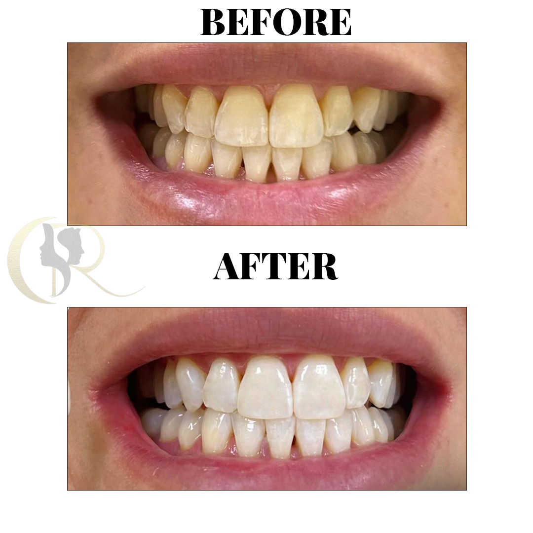 Professional Teeth Whitening in Hyderabad: Pola Office LED System