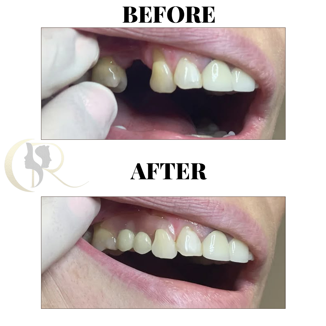 Advanced Dental Implants & Full Mouth Rehabilitation in Hyderabad