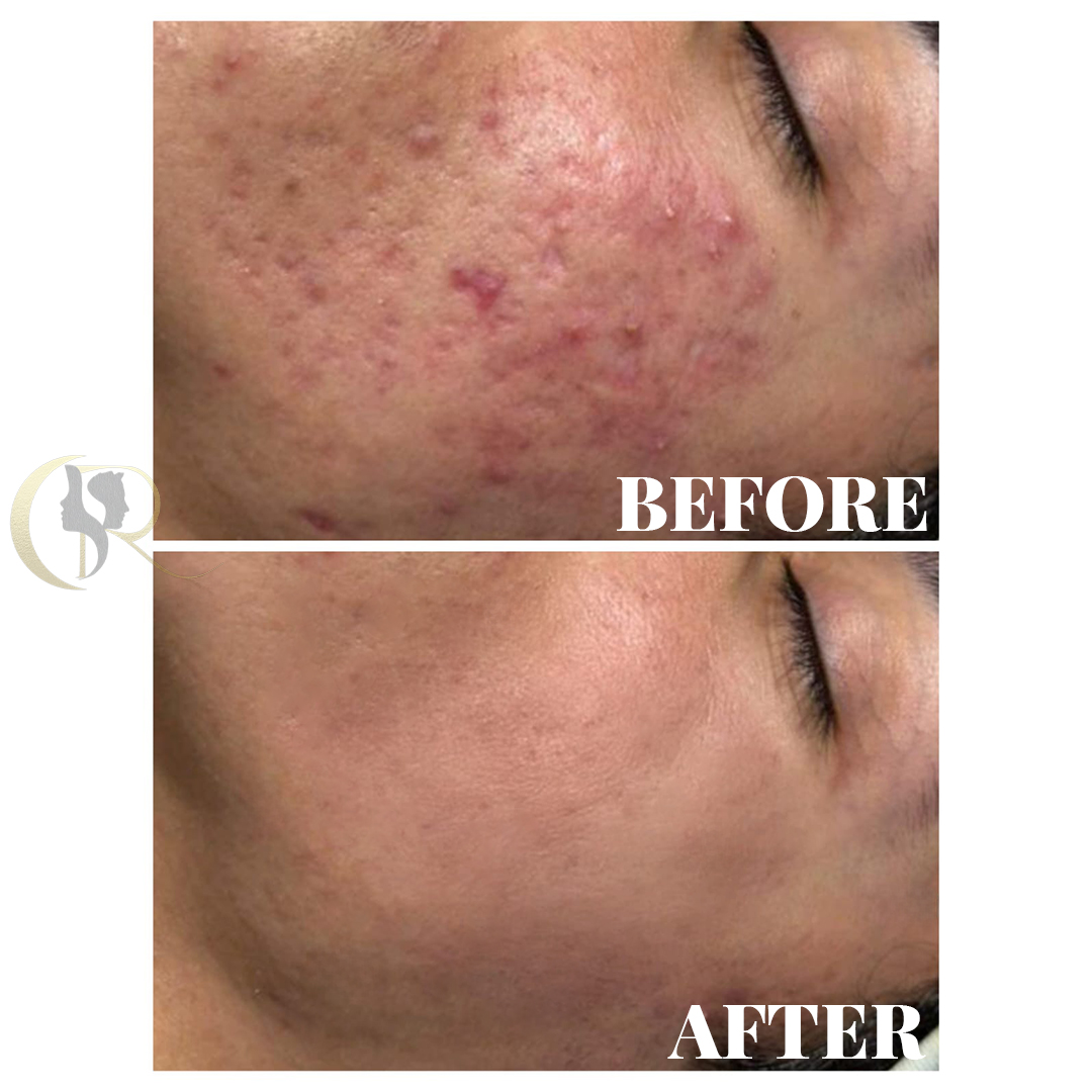 Advanced Laser Treatment for Acne Scars in Hyderabad | From ₹4,000