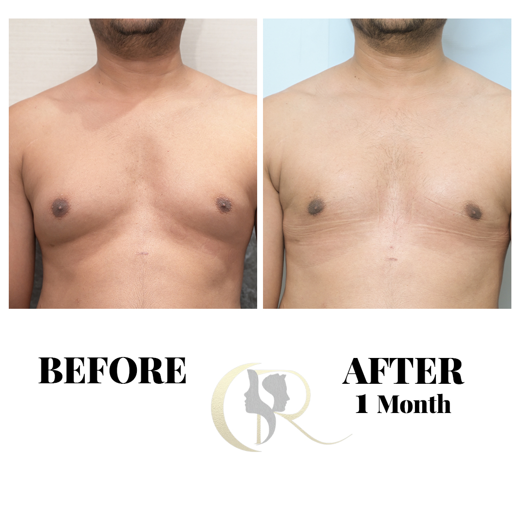 Advanced Gynecomastia Surgery in Hyderabad | Scarless Male Chest Reduction