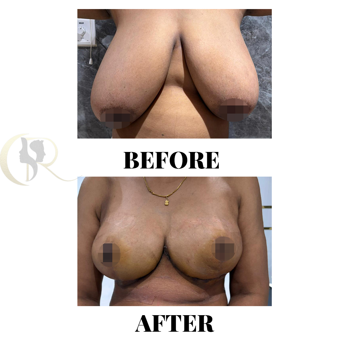 Breast Reduction Surgery in Hyderabad (Reduction Mammoplasty)