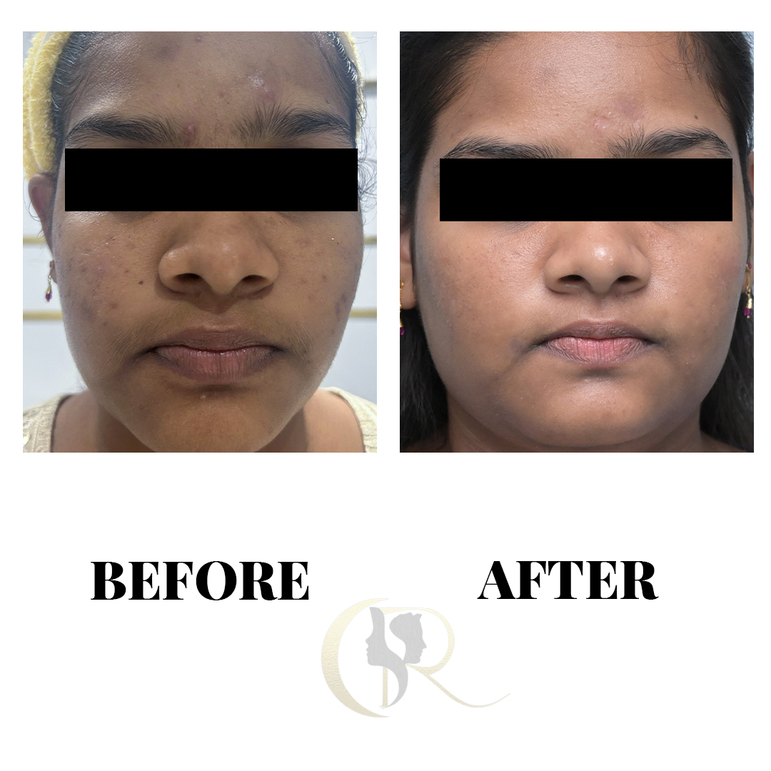 Advanced Laser Treatment for Acne Scars in Hyderabad | From ₹4,000