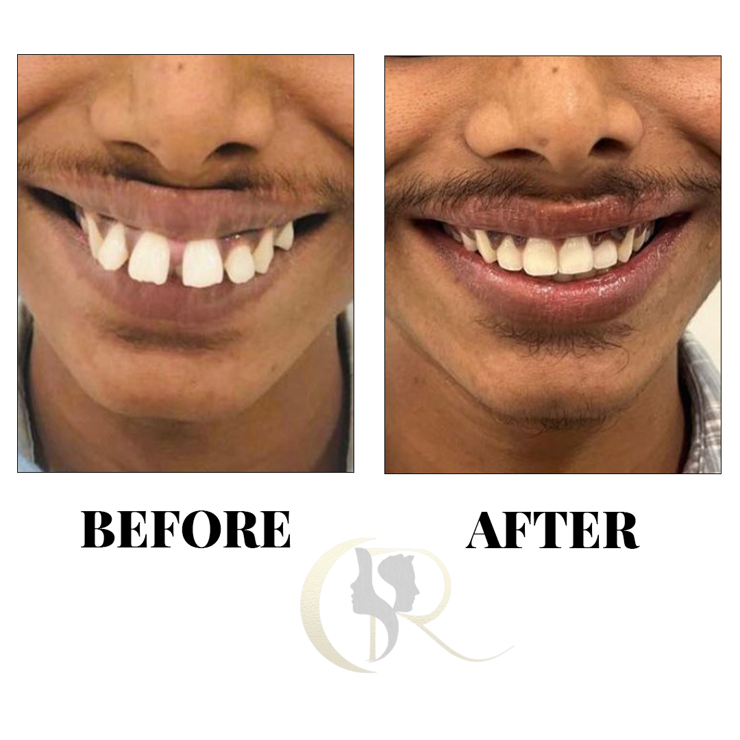 Advanced Clear Aligners in Hyderabad: Discreet Teeth Straightening