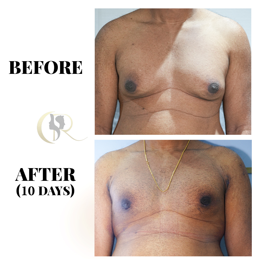 Gynecomastia Surgery in Hyderabad | Male Chest Reduction by M.Ch Surgeons