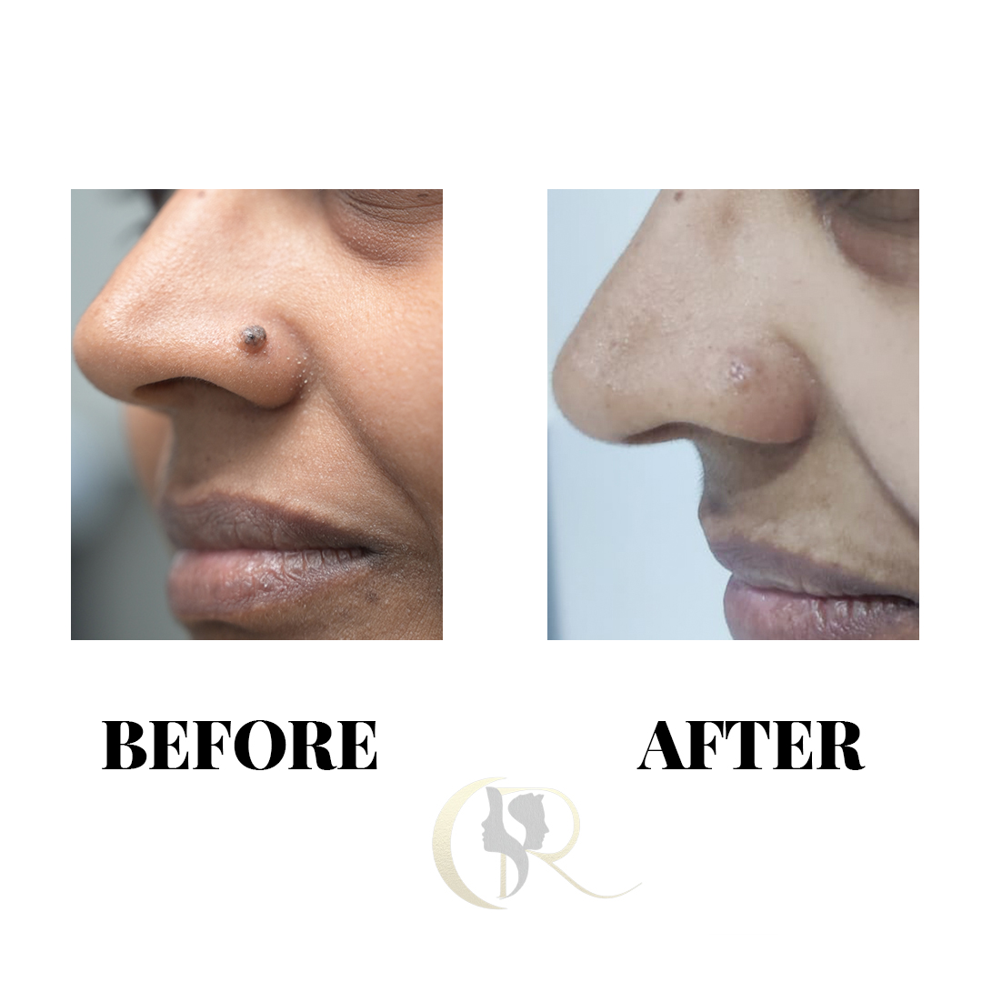 Advanced Mole, Wart & Skin Tag Removal in Hyderabad Advanced Mole, Wart & Skin Tag Removal in Hyderabad
