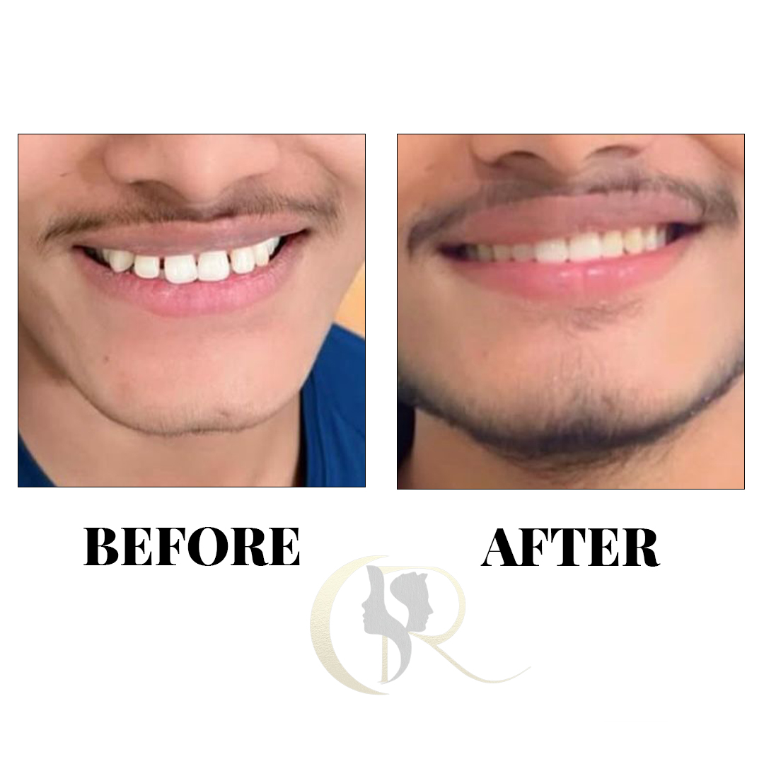 Advanced Clear Aligners in Hyderabad: Discreet Teeth Straightening