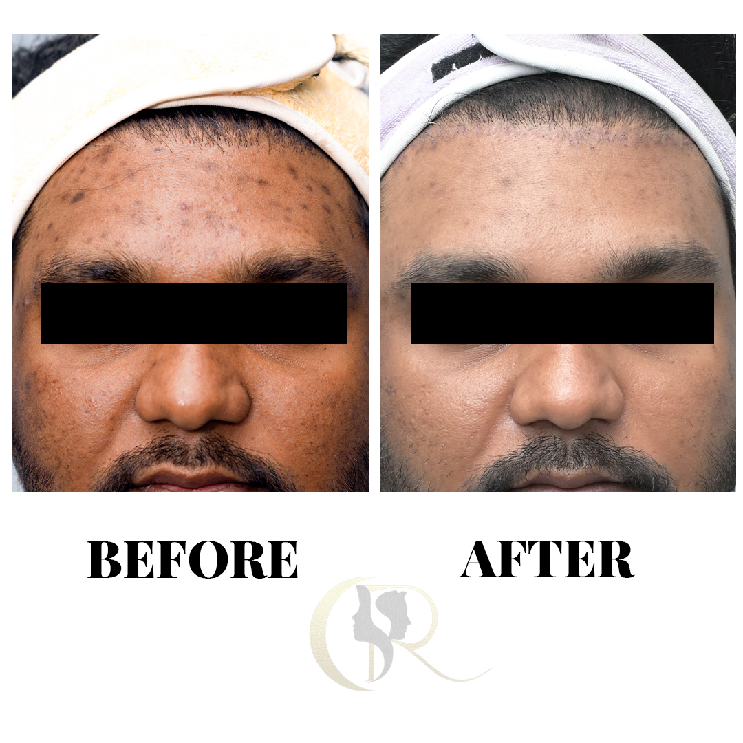 Advanced Laser Treatment for Acne Scars in Hyderabad | From ₹4,000