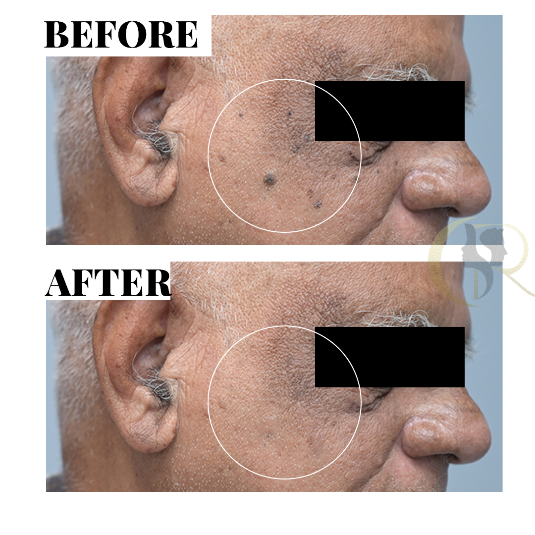 Advanced Mole, Wart &amp; Skin Tag Removal in Hyderabad | Clear Skin Solutions