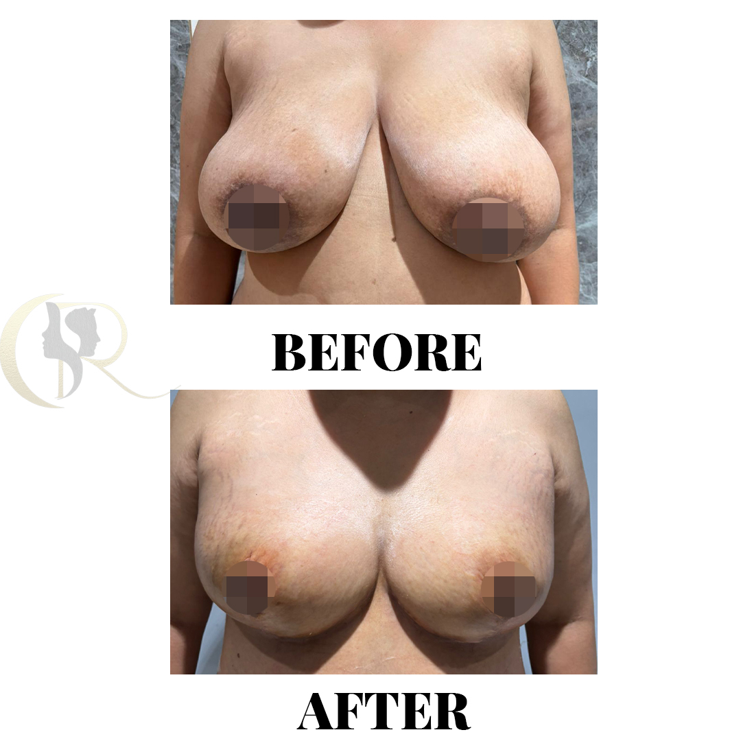 Breast Reduction Surgery in Hyderabad (Reduction Mammoplasty)