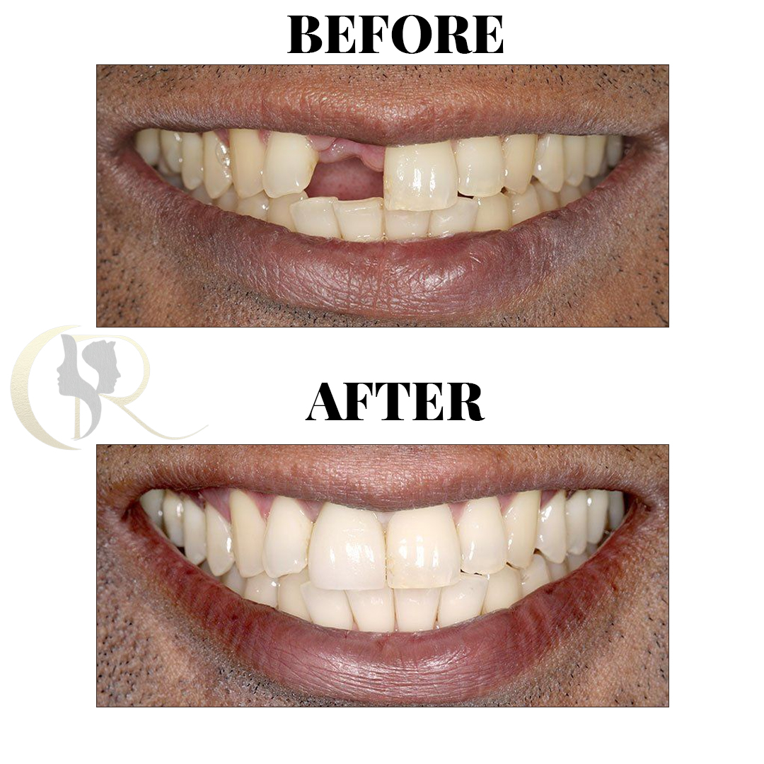 Advanced Dental Implants & Full Mouth Rehabilitation in Hyderabad
