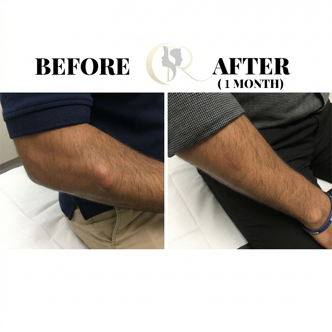 15-Min Sebaceous Cyst & Lipoma Removal in Hyderabad
