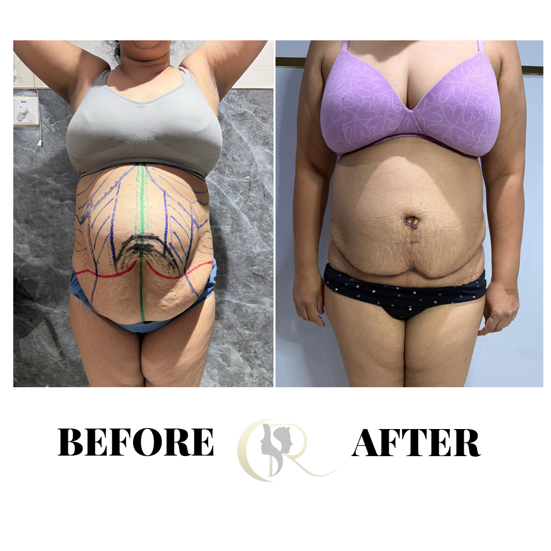VASER Liposuction in Hyderabad | High-Definition 360 Liposculpture