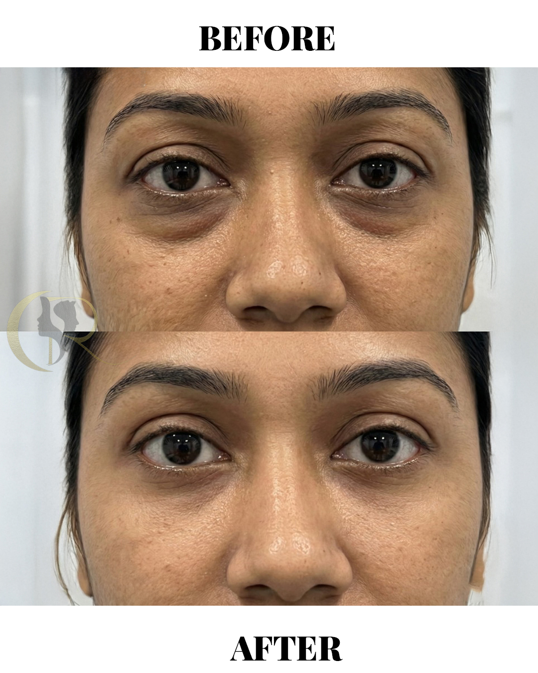 Best Blepharoplasty Surgery in Hyderabad | Eyelid & Ptosis Treatment