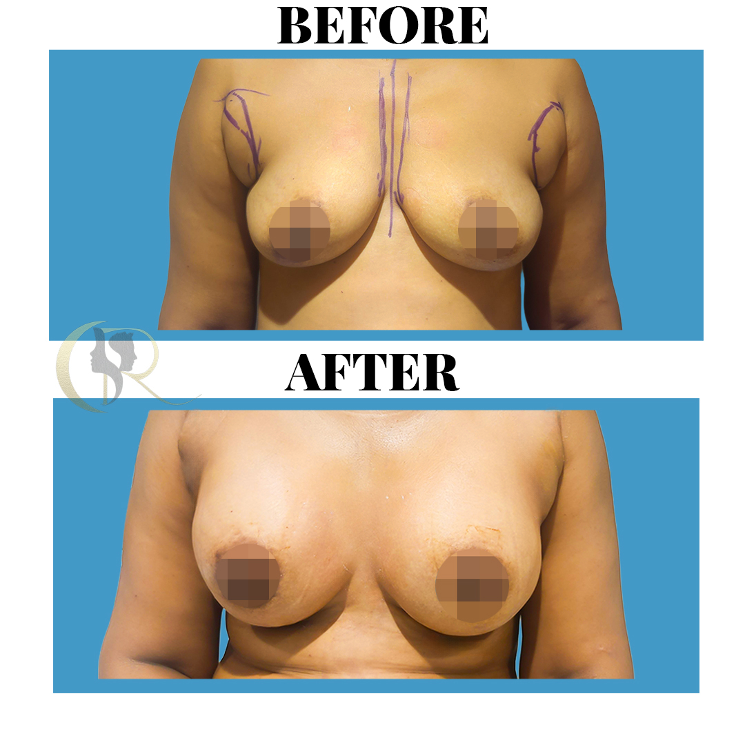 Advanced Breast Augmentation (Implants) in Hyderabad