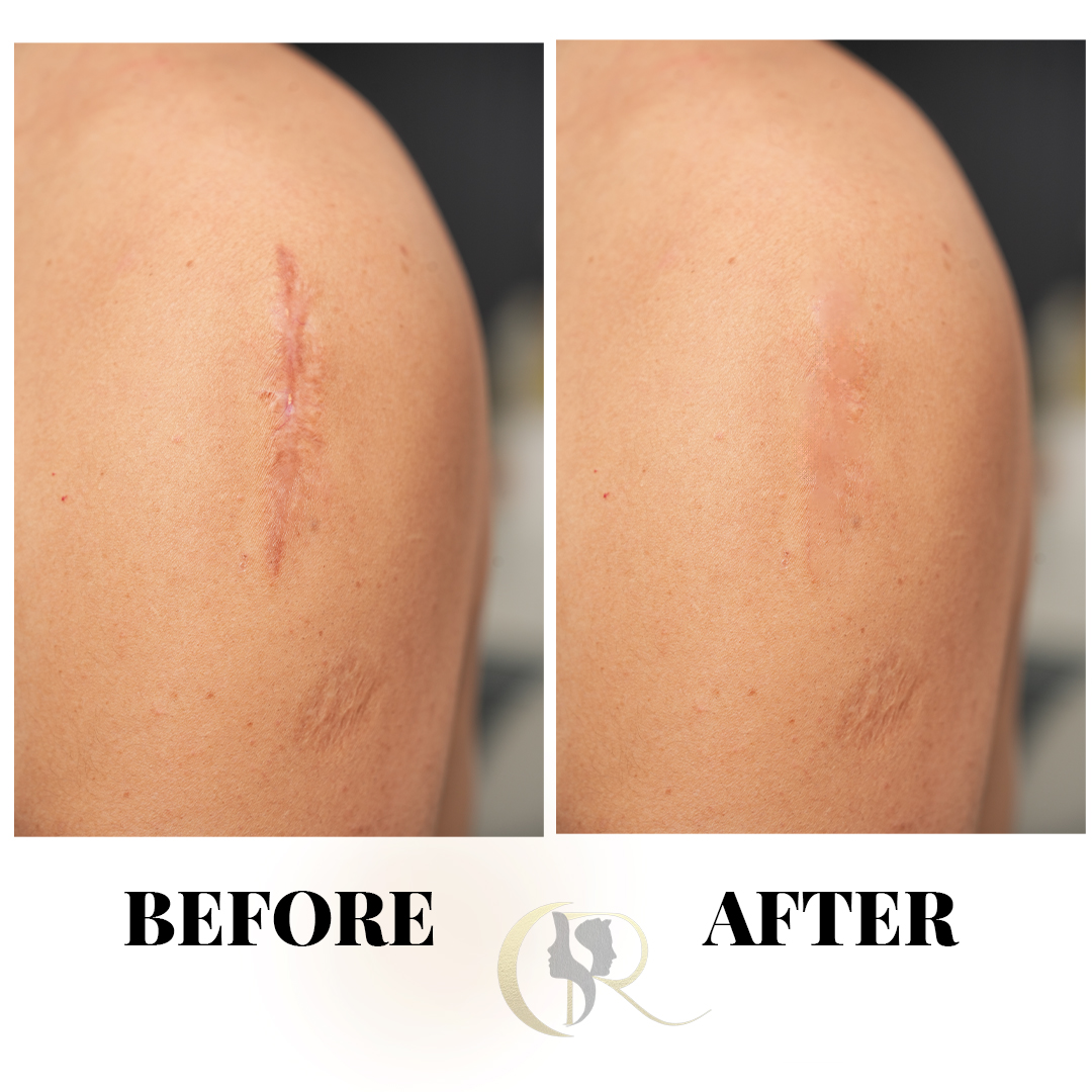 Permanent Keloid Removal & Hypertrophic Scar Treatment in Hyderabad