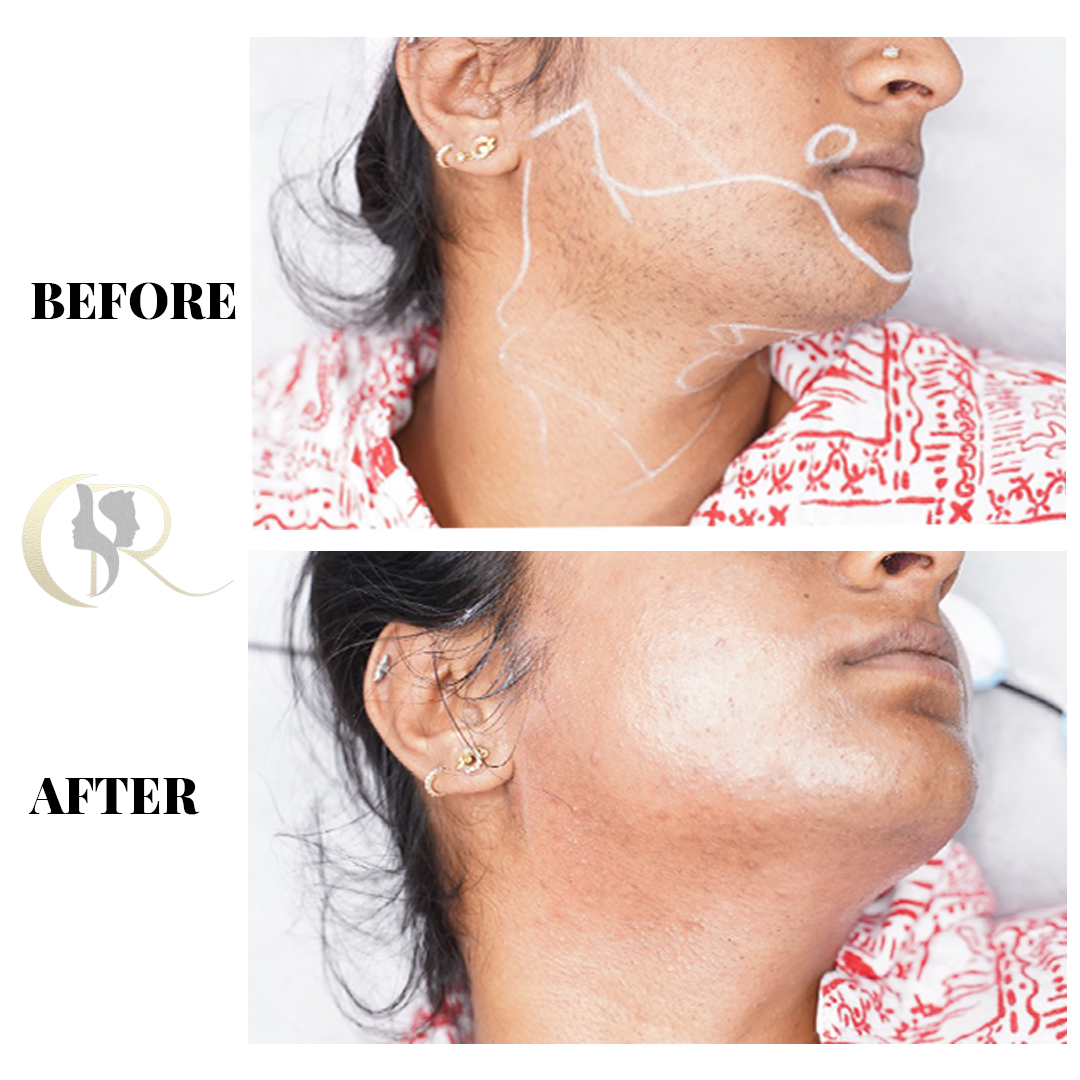 Treatment result