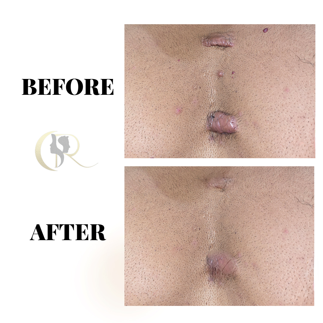 Permanent Keloid Removal & Hypertrophic Scar Treatment in Hyderabad