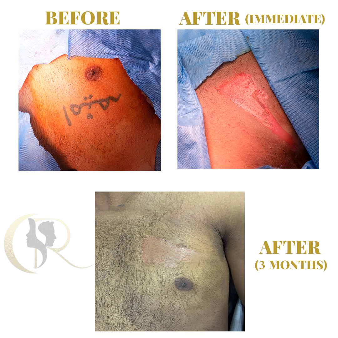 Best Tattoo Removal in Hyderabad | 1-Session Surgery & Pico Laser