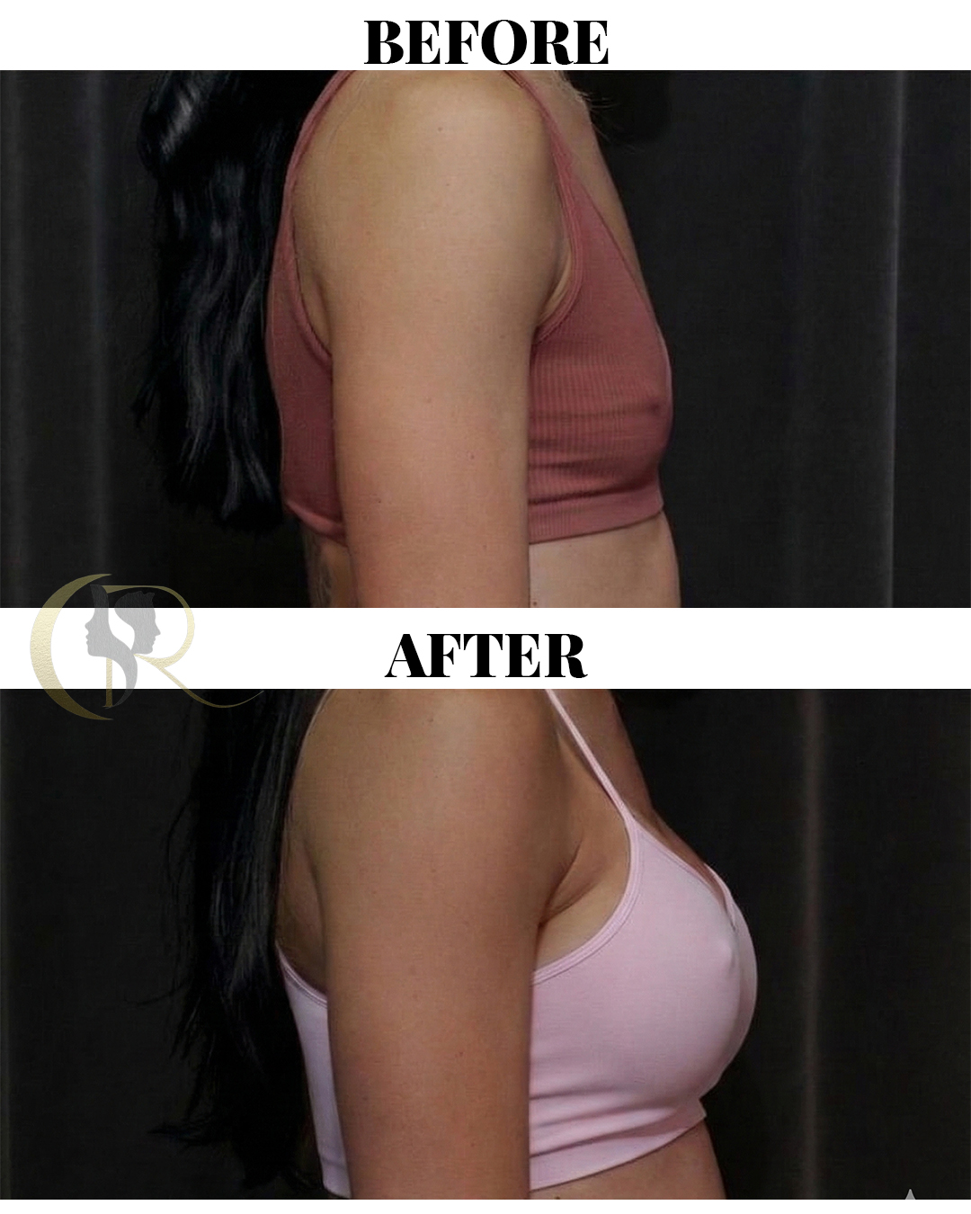 Advanced Breast Augmentation (Implants) in Hyderabad