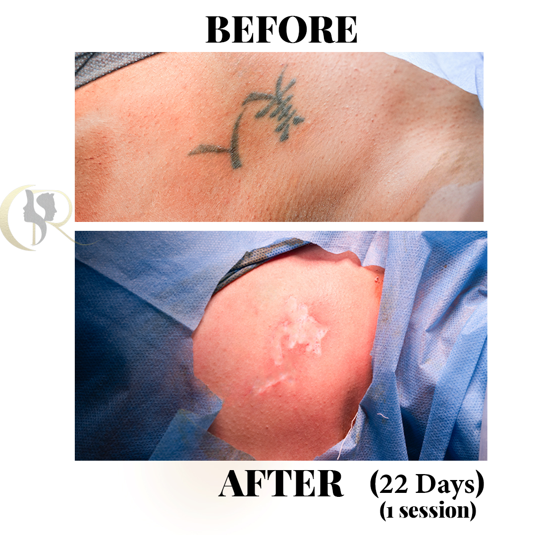 Best Tattoo Removal in Hyderabad | 1-Session Surgery & Pico Laser