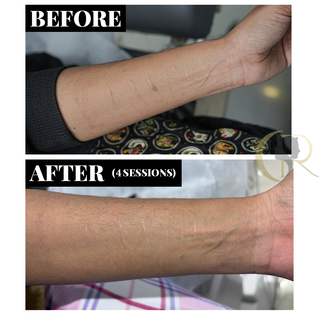 CO2 Fractional Laser & Scar Revision Surgery in Hyderabad