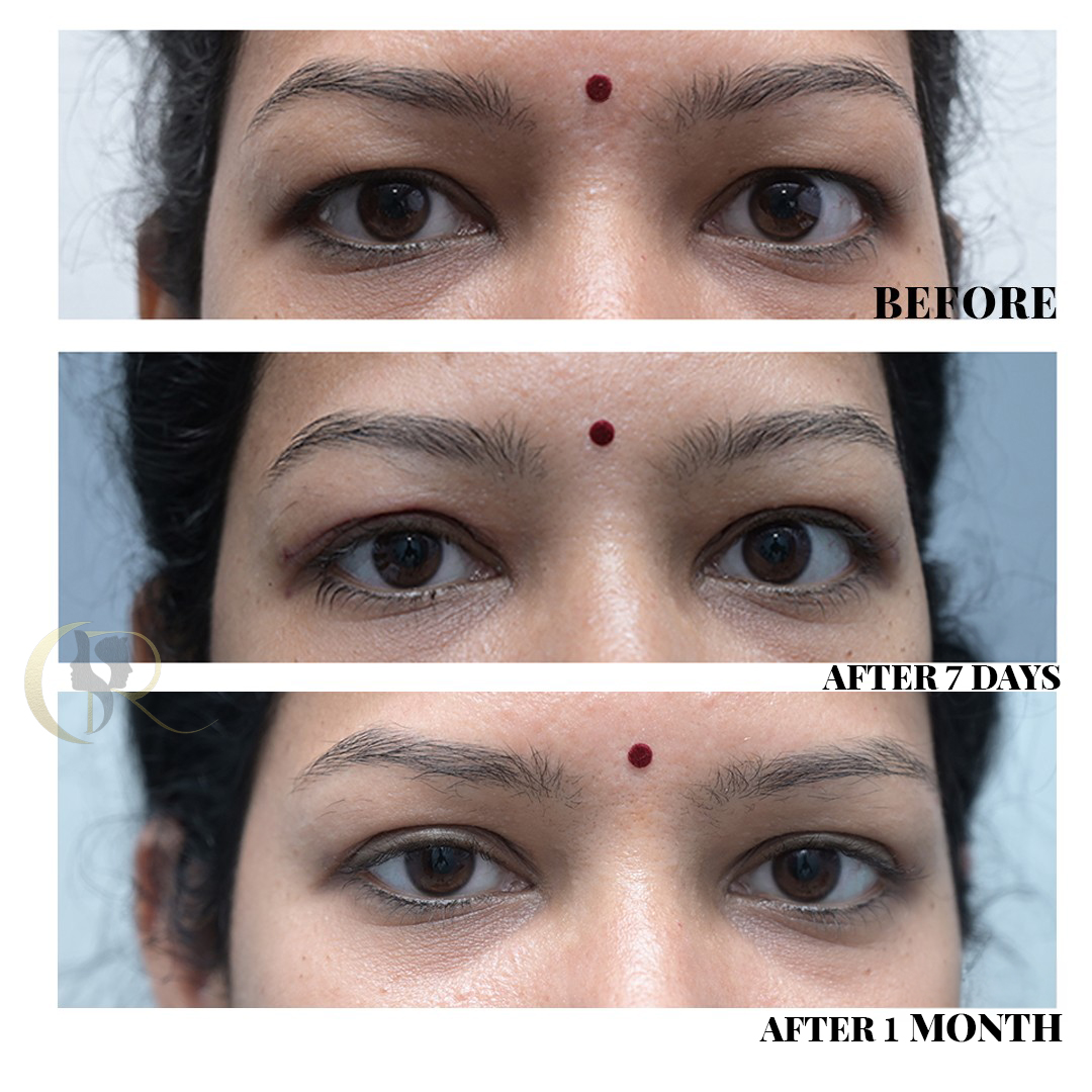 Best Blepharoplasty Surgery in Hyderabad | Eyelid & Ptosis Treatment