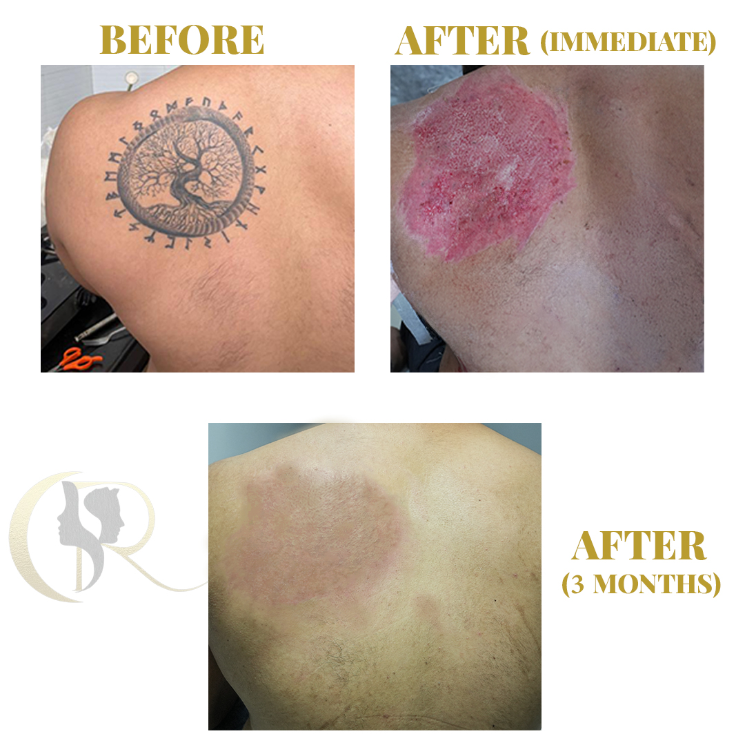 Best Tattoo Removal in Hyderabad | 1-Session Surgery & Pico Laser