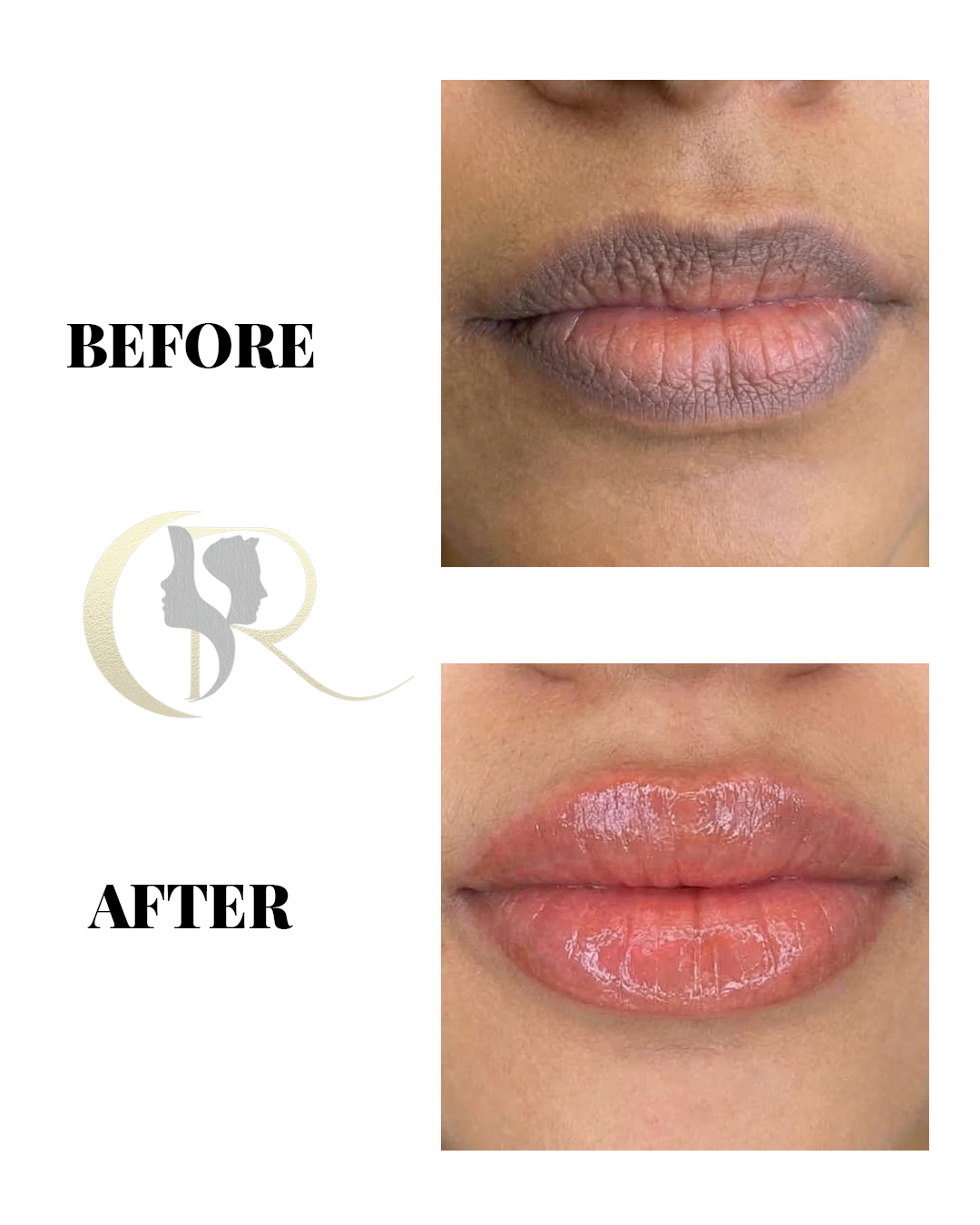 Dark Lips Treatment & Laser Lip Lightening in Hyderabad