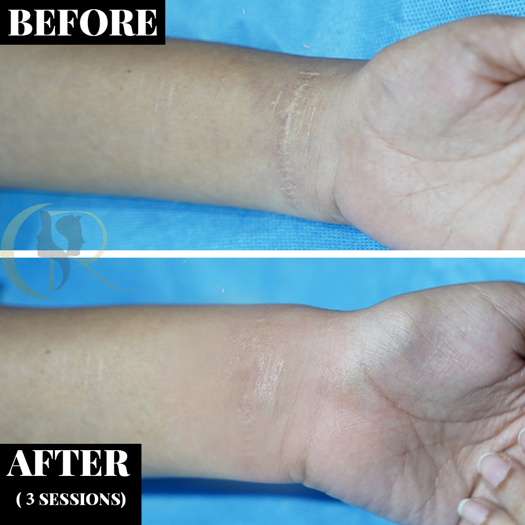 CO2 Fractional Laser & Scar Revision Surgery in Hyderabad