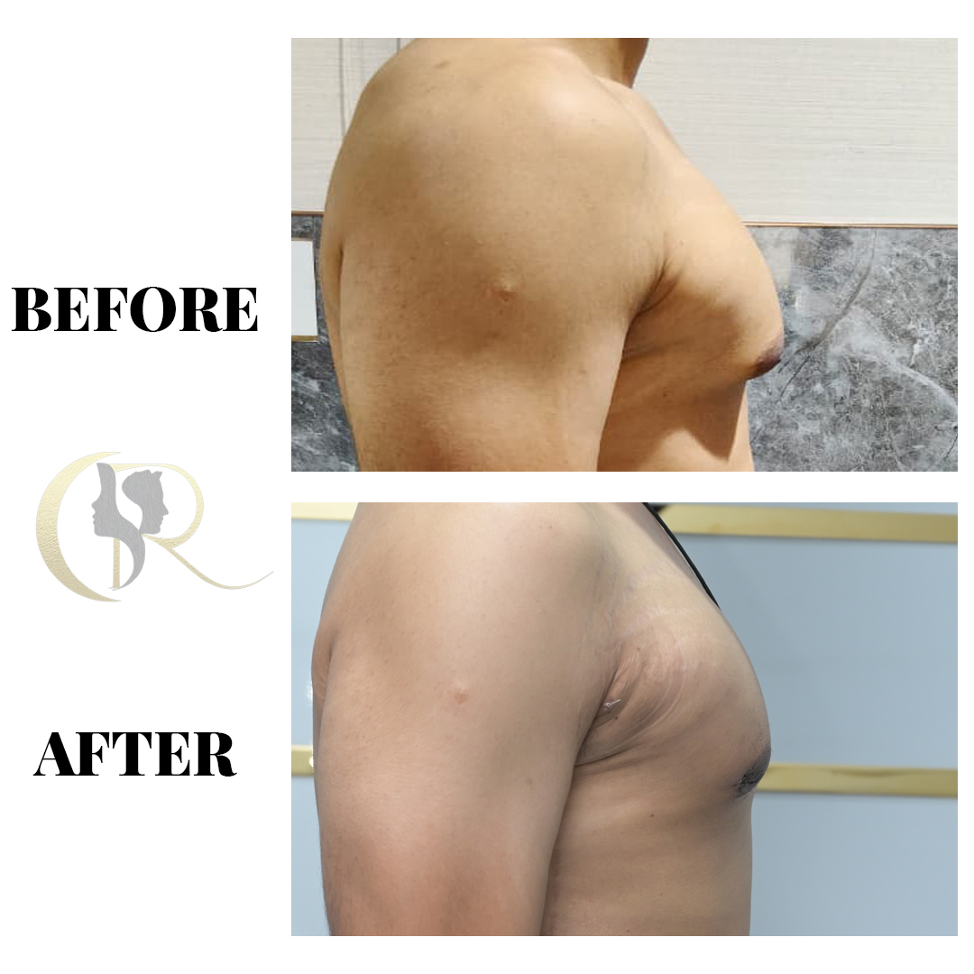 Best Gynecomastia Surgery in Hyderabad | Men Chest Fat Removal