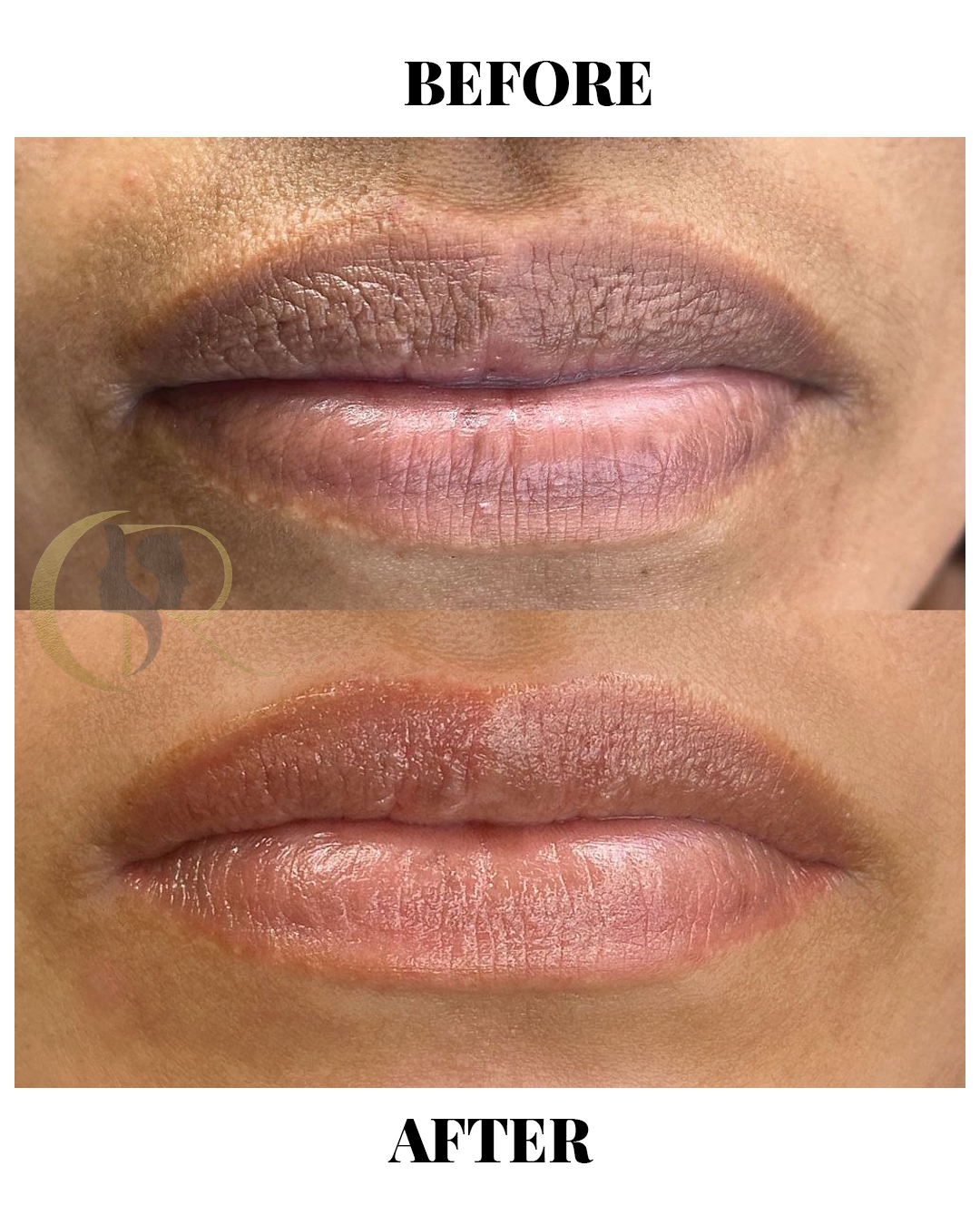 Dark Lips Treatment & Laser Lip Lightening in Hyderabad