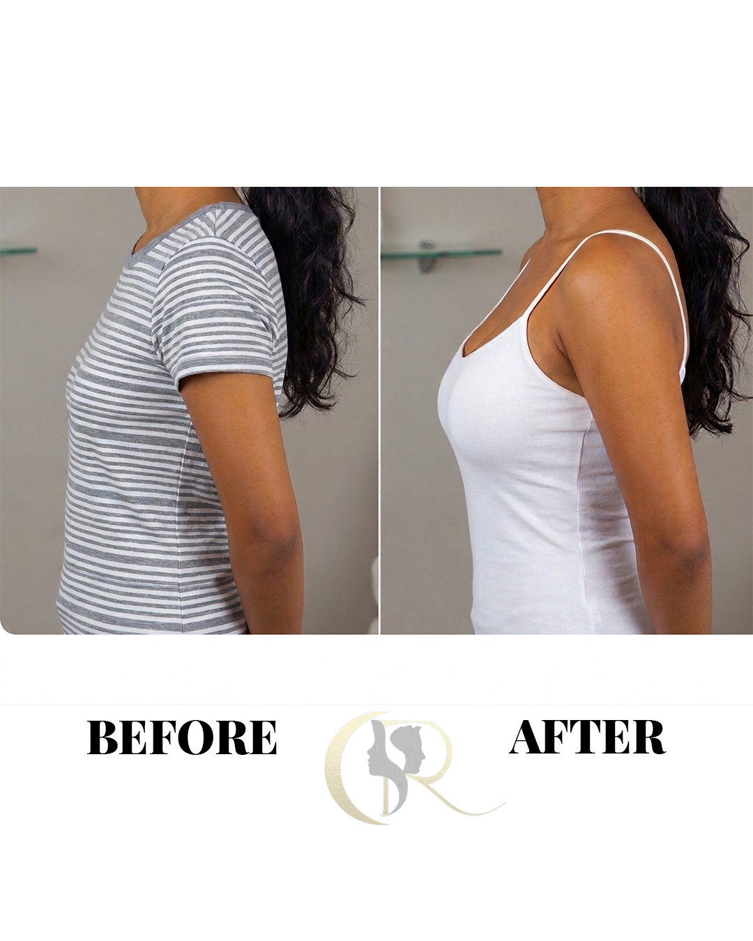 Advanced Breast Augmentation (Implants) in Hyderabad